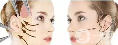 成都電波拉皮一次多少錢