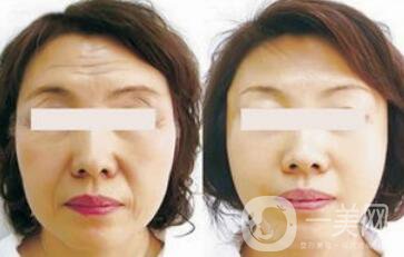 成都電波拉皮一次多少錢