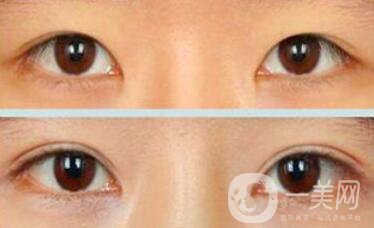 割雙眼皮為什么會(huì)成肉條