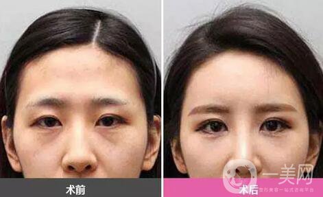 廣東自體脂肪填充淚溝多少錢？