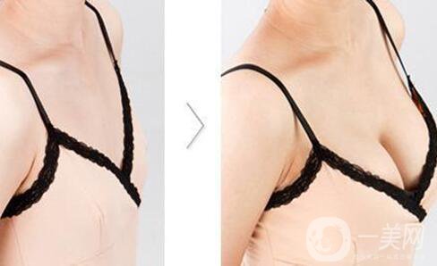 北京假體豐胸取出得多少錢