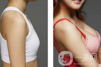 上海假體隆胸的價格高嗎？要多少錢