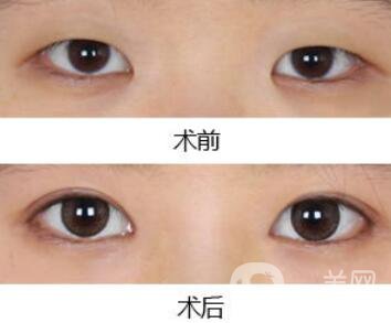 做開(kāi)眼角手術(shù)前后注意事項(xiàng)具體是什么