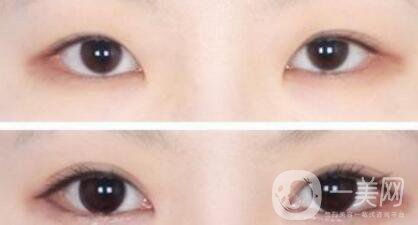 做開(kāi)眼角手術(shù)前后注意事項(xiàng)具體是什么