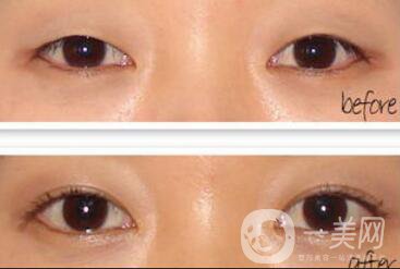 做開(kāi)眼角手術(shù)前后注意事項(xiàng)具體是什么