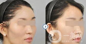 磨顴骨多久能恢復 磨顴骨價格多少