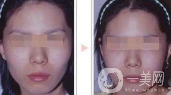 磨顴骨多久能恢復 磨顴骨價格多少