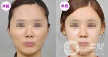 磨顴骨多久能恢復 磨顴骨價格多少