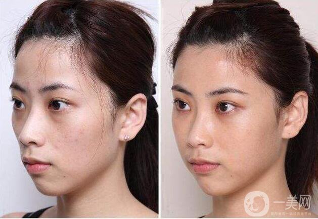 膠原蛋白豐蘋果肌,膠原蛋白豐蘋果肌*果,膠原蛋白豐蘋果肌價(jià)格