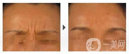 *去眉間紋,深圳*去眉間紋多少錢,*去眉間紋注意事項(xiàng)