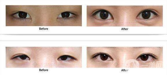 昆明割雙眼皮手術的價格一般是多少錢