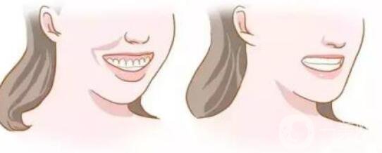 頜骨矯正,北京頜骨矯正價(jià)格,頜骨矯正注意事項(xiàng)