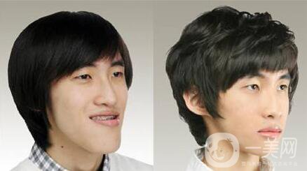 頜骨矯正,北京頜骨矯正價(jià)格,頜骨矯正注意事項(xiàng)