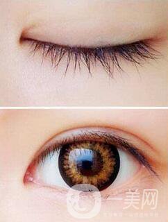 開完眼角怎么預(yù)防增生？