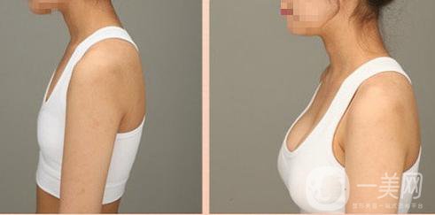 假體豐胸*果怎樣 手術(shù)*嗎