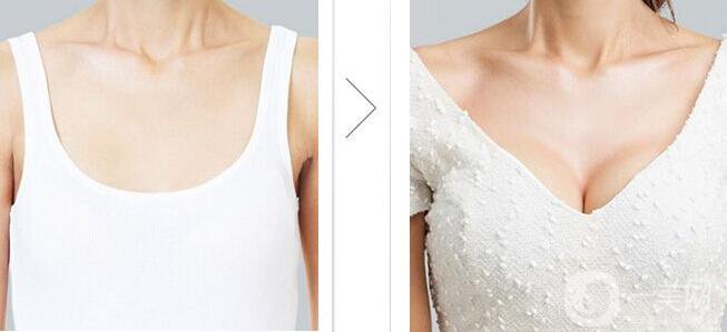 假體豐胸,假體豐胸注意事項(xiàng)