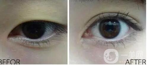 韓式開眼角,廣州韓式開眼角多少錢