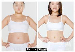 激光溶脂減肥術(shù)后還會反彈嗎