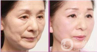 整形拉皮除皺手術(shù)多少錢 術(shù)后護理怎么做