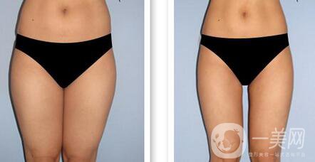 溶脂刀有什么危害 術(shù)后護(hù)理應(yīng)該怎么做