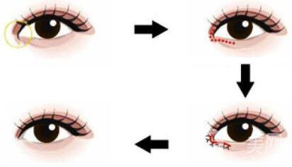 開眼角手術(shù)價格 價格影響因素分析