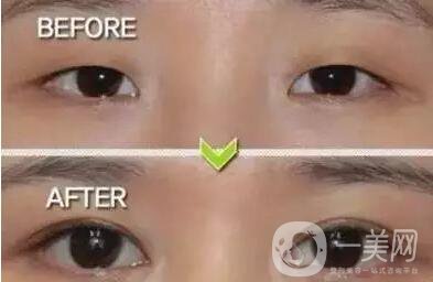 上海開(kāi)眼角雙眼皮多少錢,上海開(kāi)眼角多少錢,上海割雙眼皮多少錢