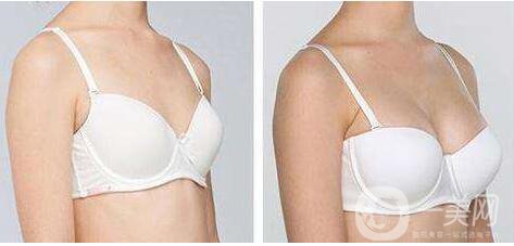 隆胸手術(shù),隆胸手術(shù)風(fēng)險