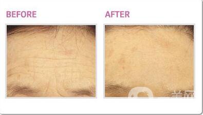 熱瑪吉,熱瑪吉*果,熱瑪吉費(fèi)用