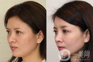 自體脂肪豐蘋果肌術(shù)后護(hù)理主要要做些什么