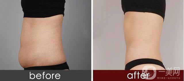 廣州溶脂減肥價格,溶脂減肥注意事項