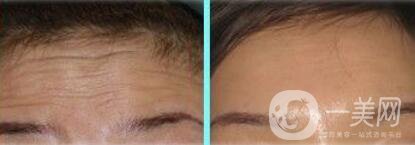 玻尿酸去抬頭紋打幾支才*果