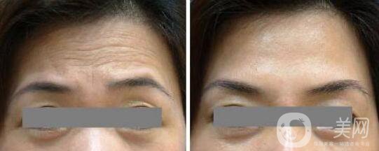 玻尿酸去抬頭紋打幾支才*果