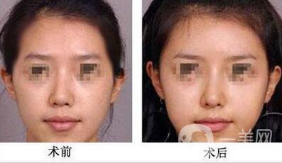 自體脂肪豐太陽(yáng)穴多久消腫