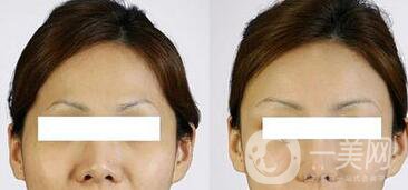 自體脂肪豐太陽(yáng)穴多久消腫