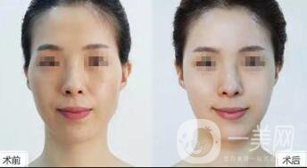 自體脂肪豐太陽(yáng)穴多久消腫