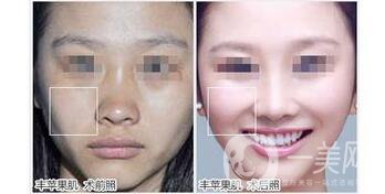 杭州自體脂肪豐蘋果肌多少錢