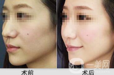 杭州自體脂肪豐蘋果肌多少錢