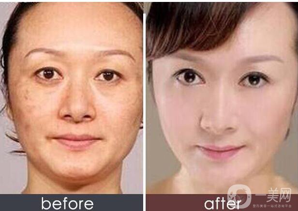 面部拉皮,面部拉皮多少錢,深圳面部拉皮多少錢