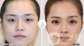 玻尿酸豐臥蠶術后護理怎么做