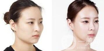 磨顴骨注意事項具體有哪些