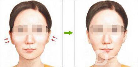 磨顴骨注意事項具體有哪些