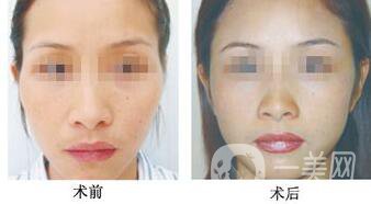 磨顴骨注意事項具體有哪些