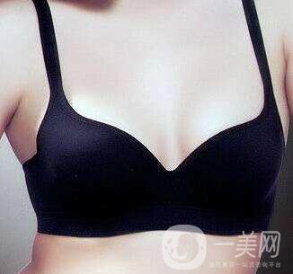 副乳切除術有后遺癥嗎？