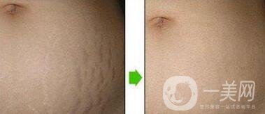 廣東激光去妊娠紋大概多少錢