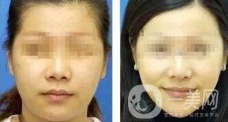 玻尿酸豐太陽(yáng)穴術(shù)后護(hù)理注意事項(xiàng)有哪些