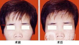 玻尿酸豐太陽(yáng)穴術(shù)后護(hù)理注意事項(xiàng)有哪些