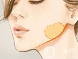 去頰脂墊瘦臉多少錢？