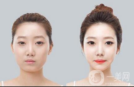 自體脂肪豐太陽穴*果能維持多久？