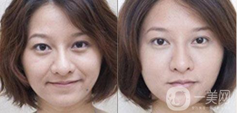 上海法令紋打針多少錢 術(shù)后能維持多久