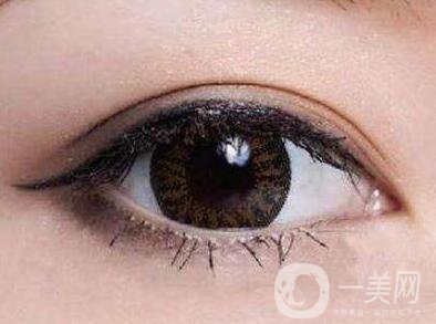 怎樣判斷雙眼皮增生了呢？